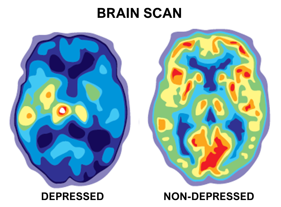 PET scan of depressed and non depressed brains